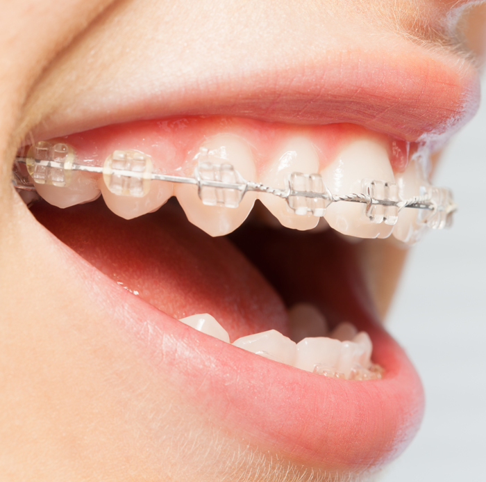 Ceramic Braces - What To Know - Summit Dental & Orthodontics