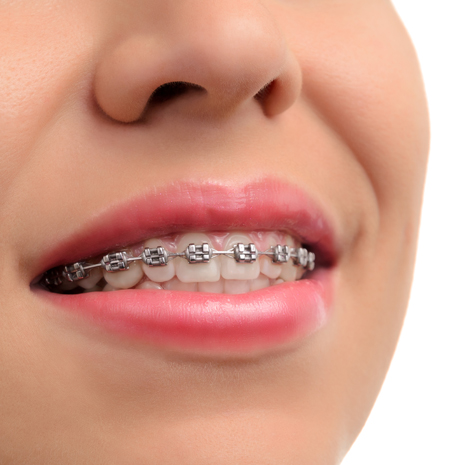 Types of Braces Used in Orthodontics [5 Best Choice]